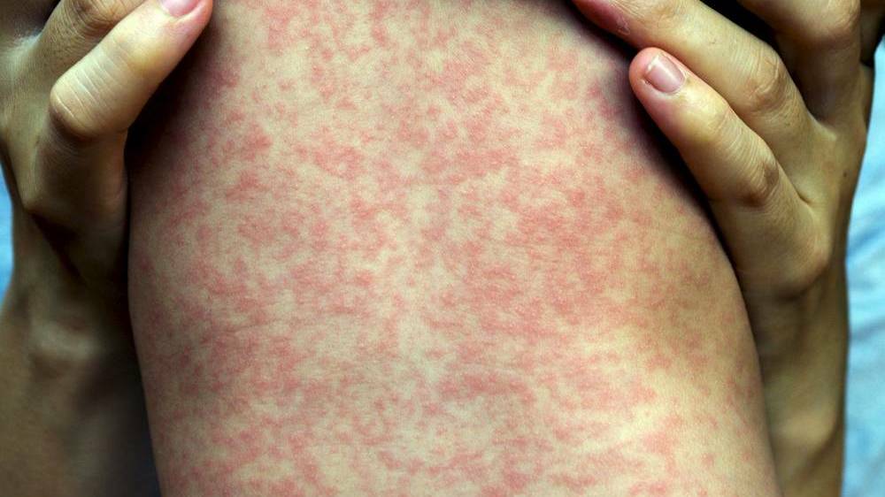 NSW Health has urged travellers to be fully vaccinated against measles after another case was identified. Photo: File